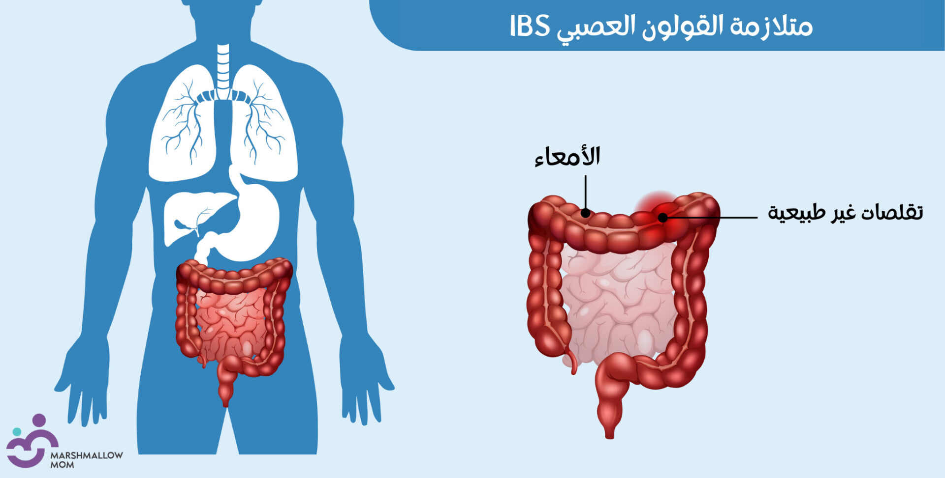 متلازمة القولون العصبي IBS