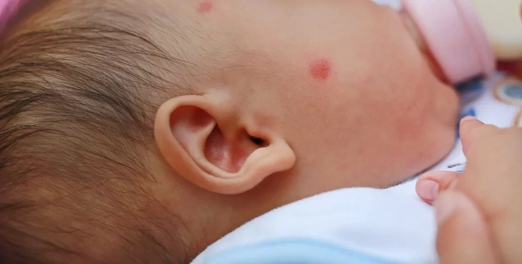 الطفح الجلدي عند الأطفال الرضع